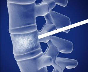 vertebroplastika-2